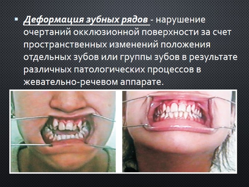 Деформация зубных рядов - нарушение очертаний окклюзионной поверхности за счет пространственных изменений положения отдельных